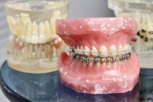 Dental Implants Aesthetics