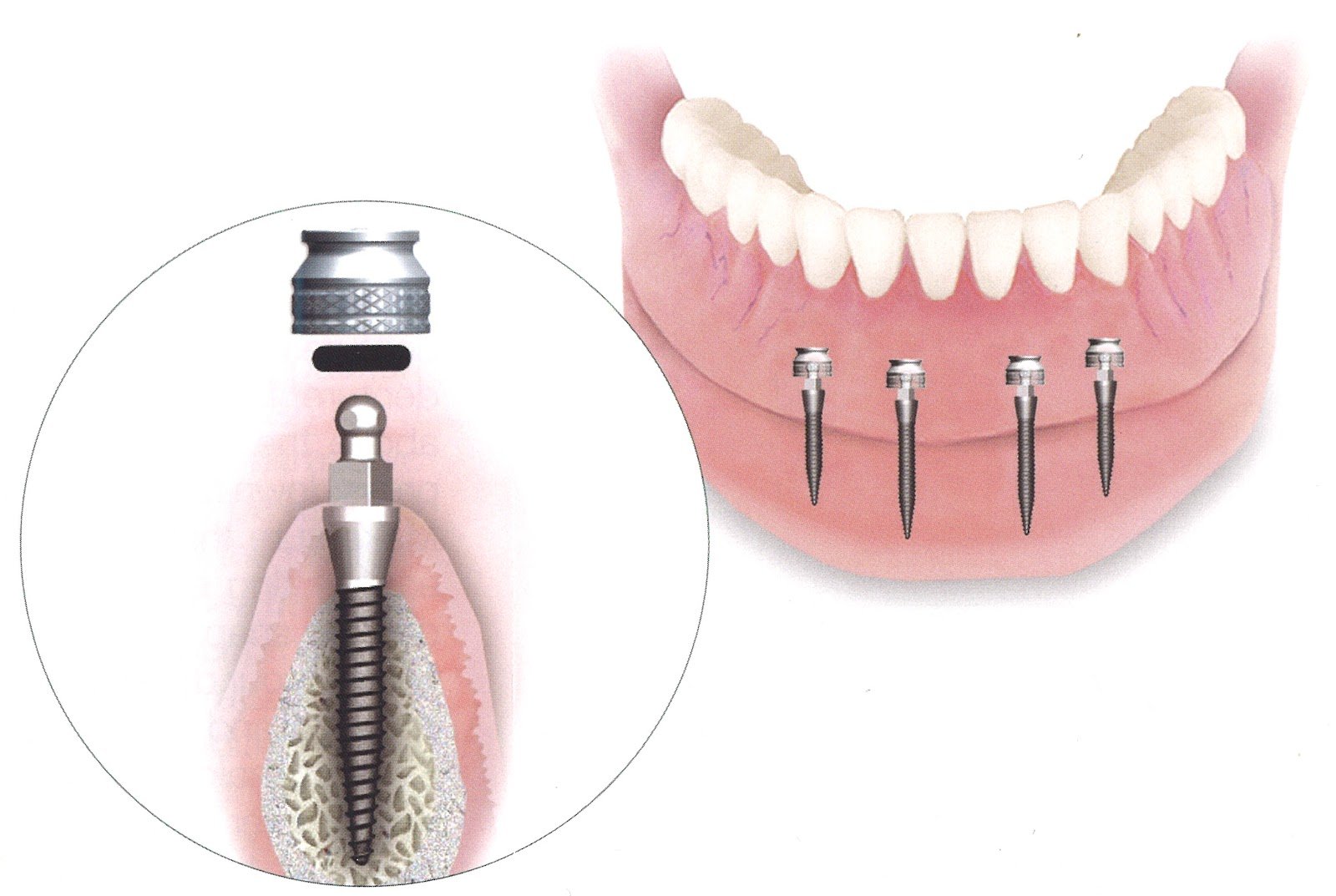 Mini Dental Implants  