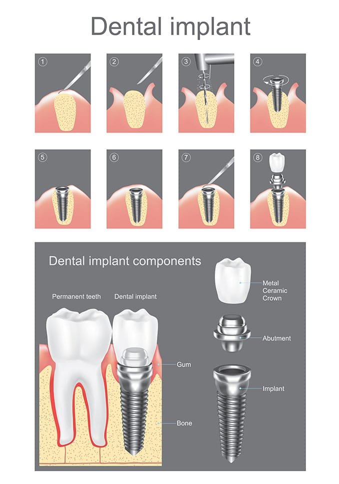 Dental Implants Components