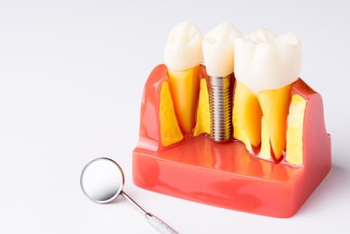 Dental Implants