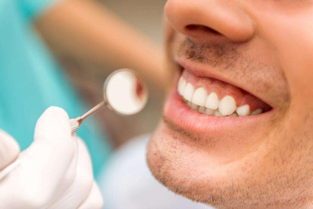 Teeth-whitening - Richmond Hill