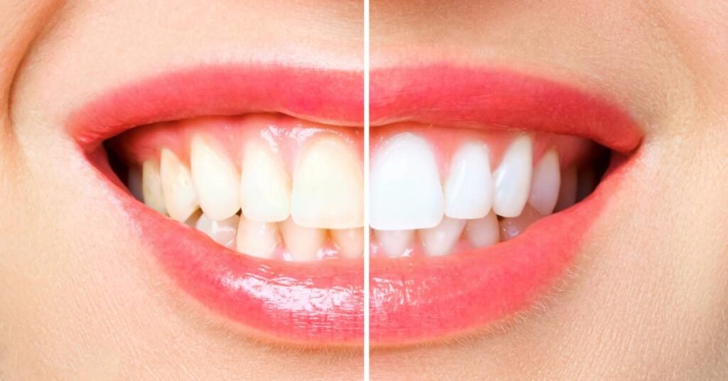 teeth whitening richmond bc