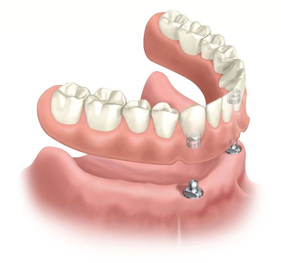 cost of implant dentures