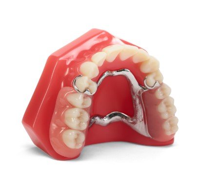 metal partial denture