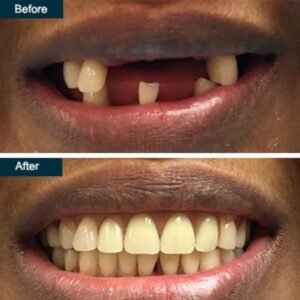 partial dentures before and after