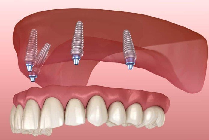 problems with snap-in dentures