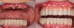 upper denture implants