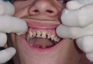 Bad Dentures Pictures