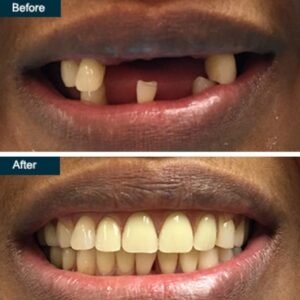 Before and after partial dentures