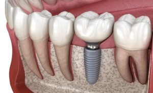 lower denture implants cost