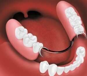 partial dentures for back teeth