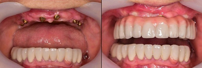 Dentures Before and After