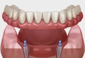 Lower Denture Implants
