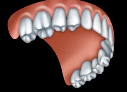 Partial Dentures for Molars