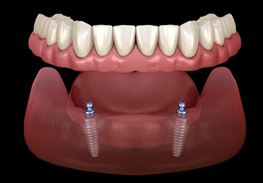 Mini Dental Implants