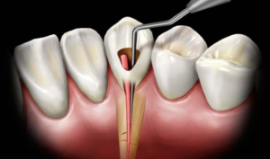 Root Canal Recovery Timeline