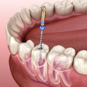 Root canal before and after