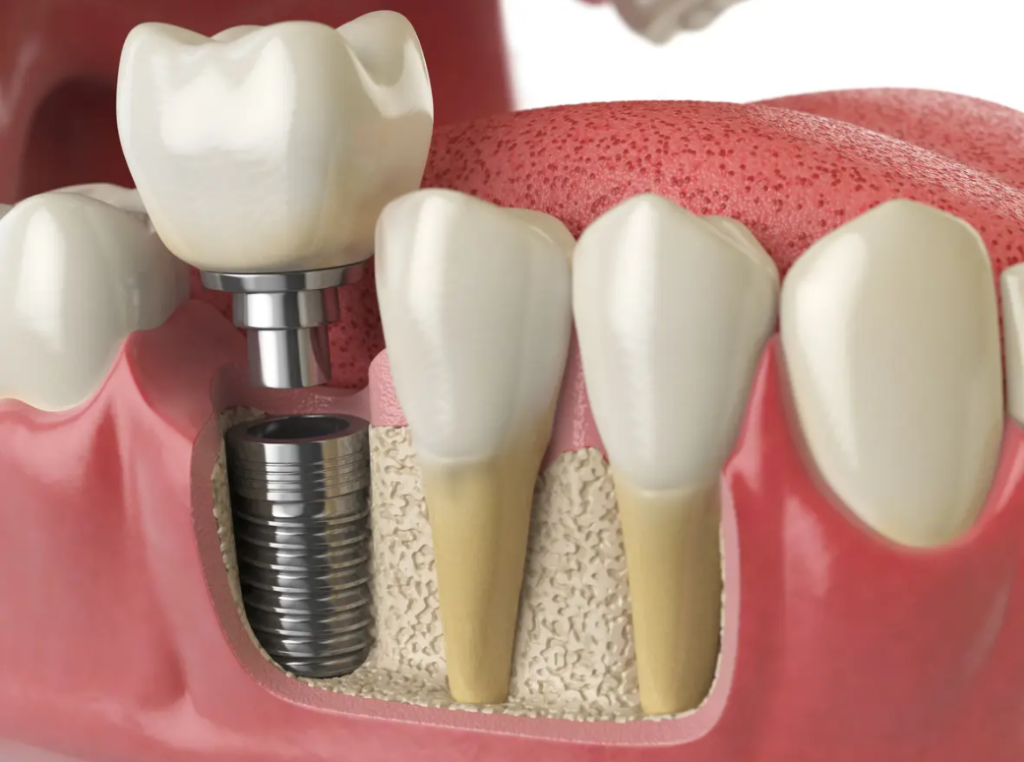 celebrity dental implants before and after