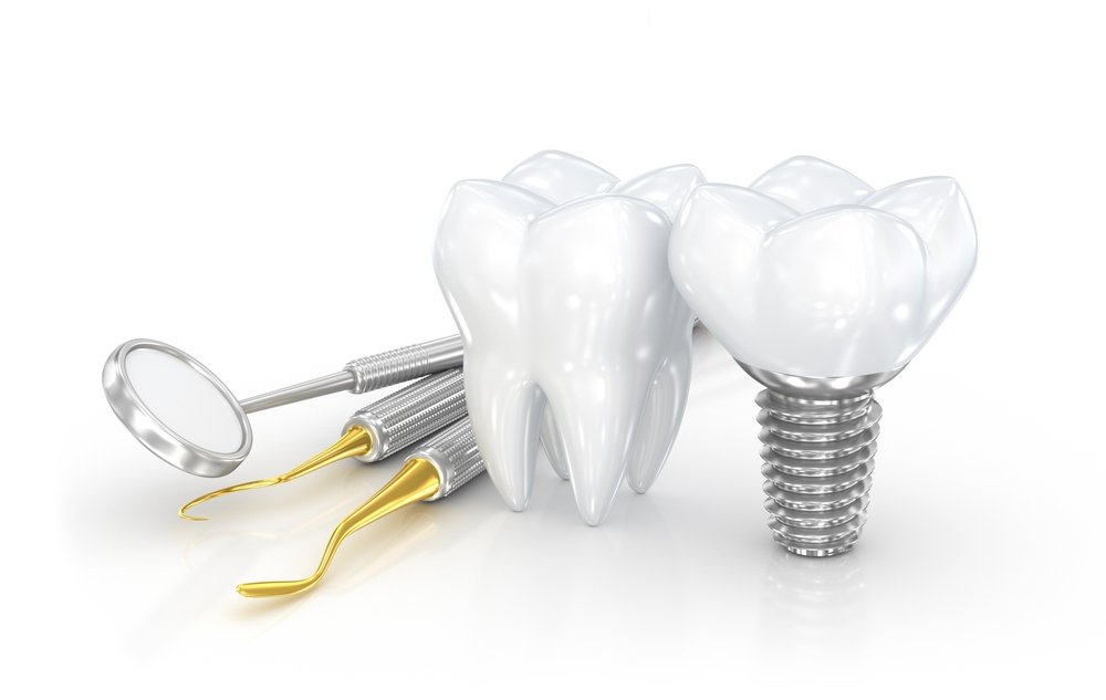 dental implants cost