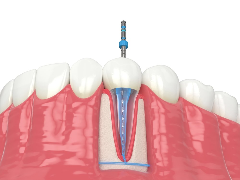 are root canals bad for you