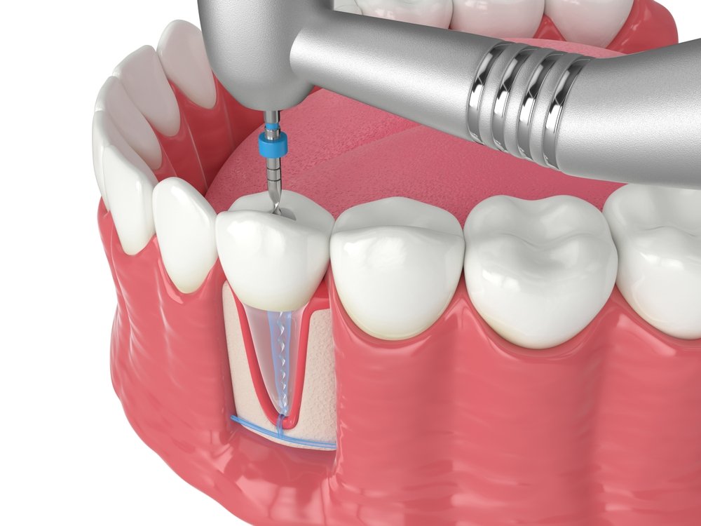 how much is a root canal in ontario