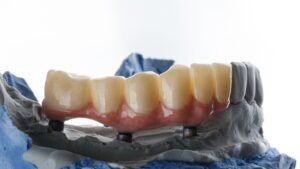 ill-fitting dental bridge