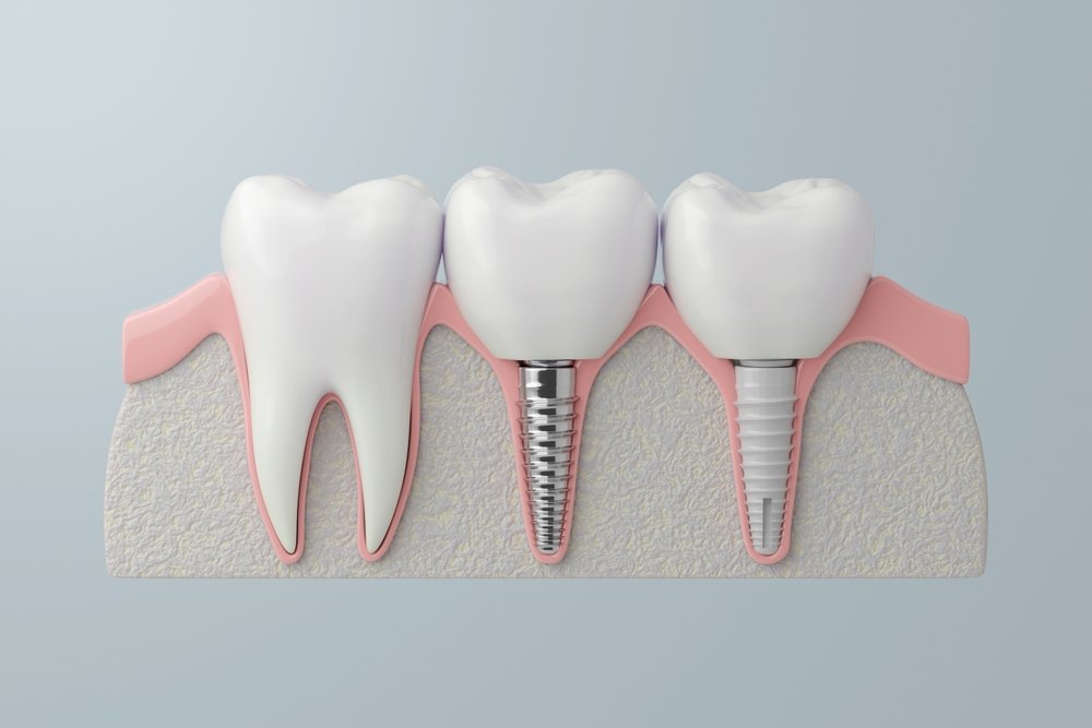 odsp dental implants