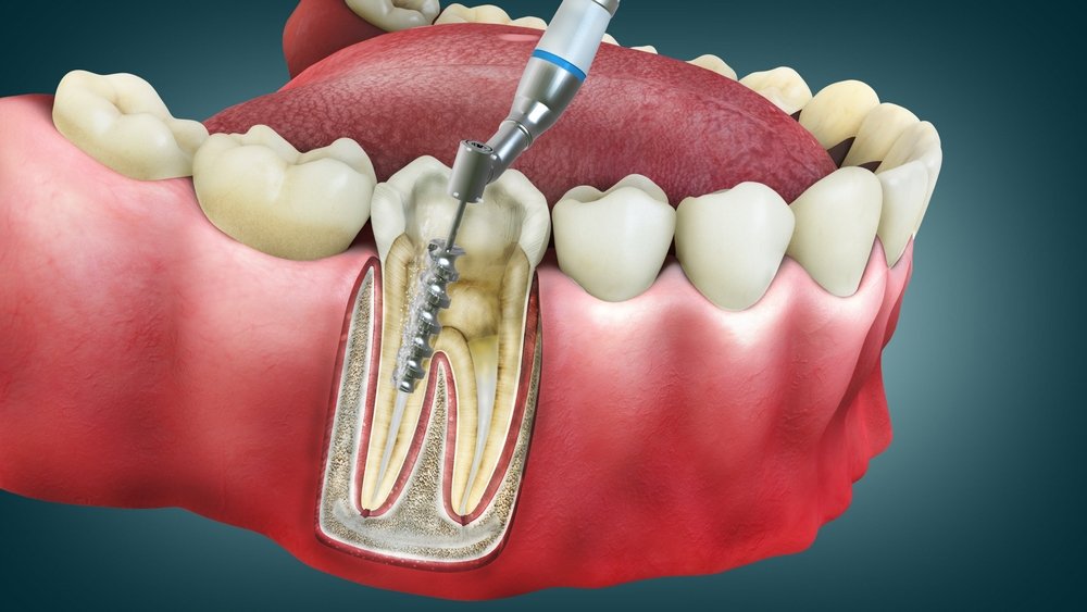 root canal cost in Richmond Hill