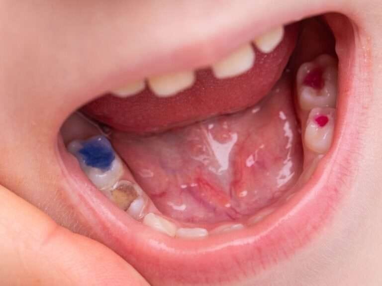 How Much Is A Tooth Filling Without Insurance Hummingbird Dental