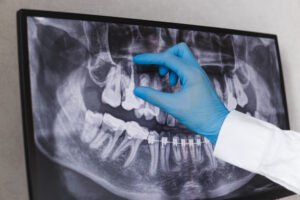 root canal cost ontario