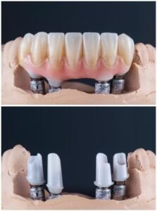 what is a hybrid denture