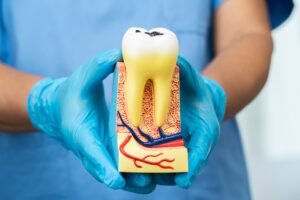 how to avoid root canal