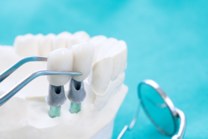 dental implant cost