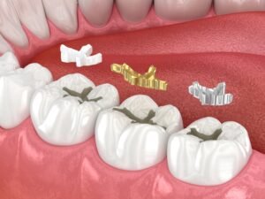 gold denture teeth