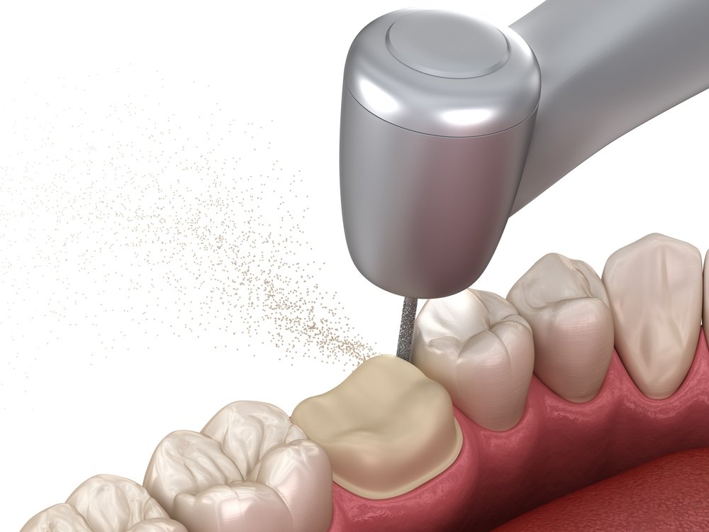 how long does it take for a root canal procedure