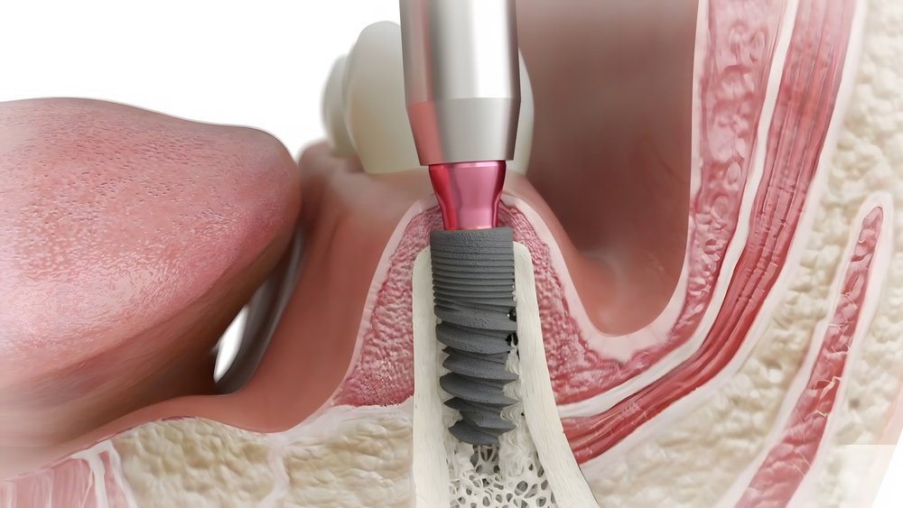 Full mouth dental implants cost Canada