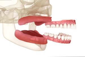 Lower partial dentures bottom front teeth