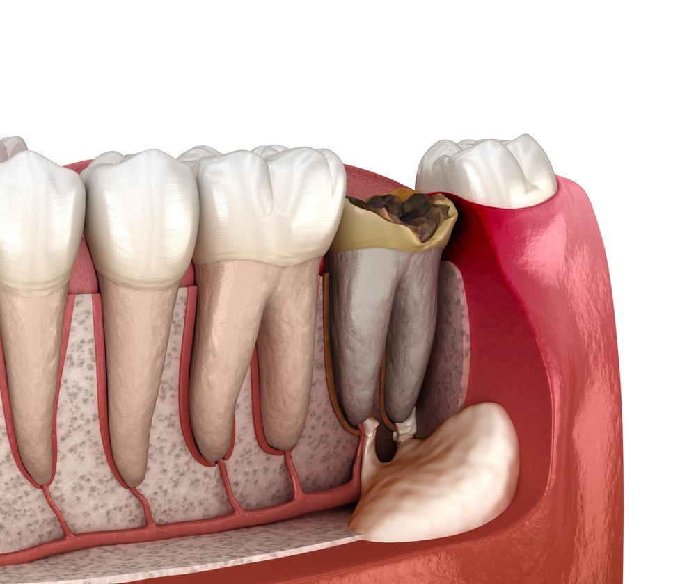 root canal cost calgary