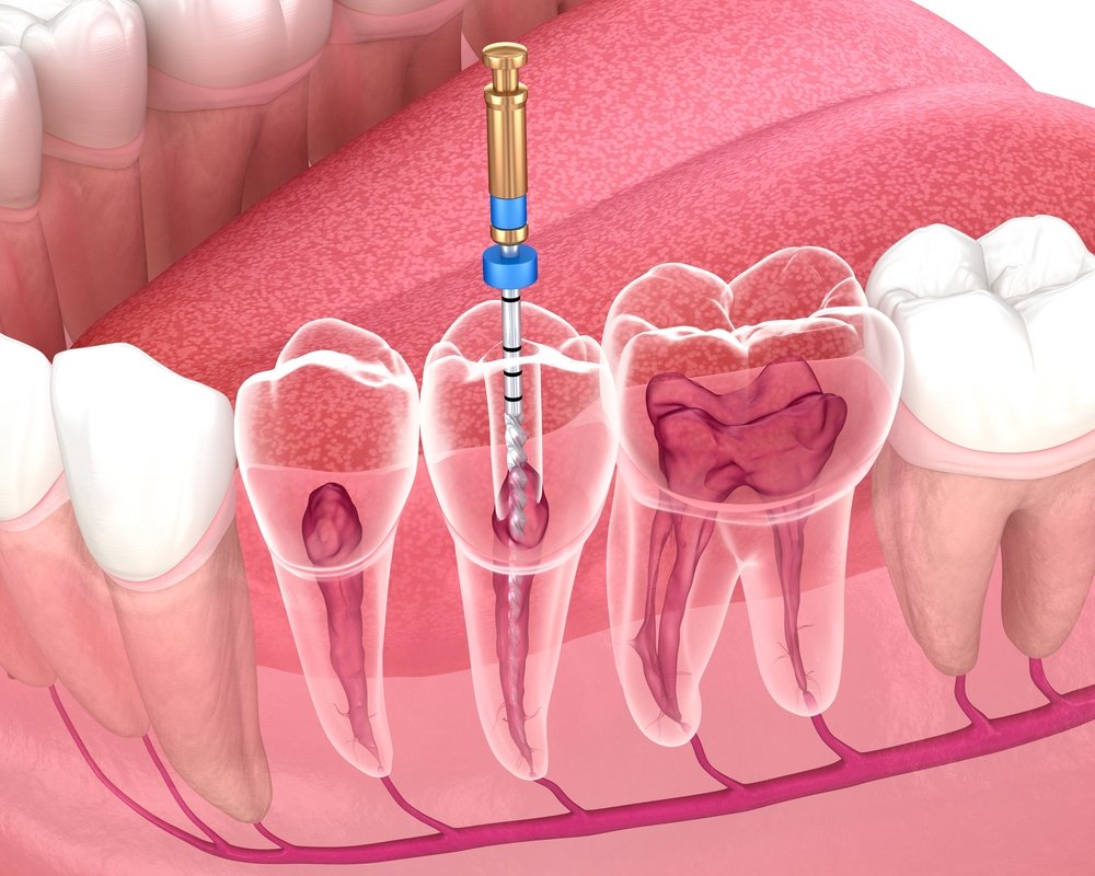 root canal healing time