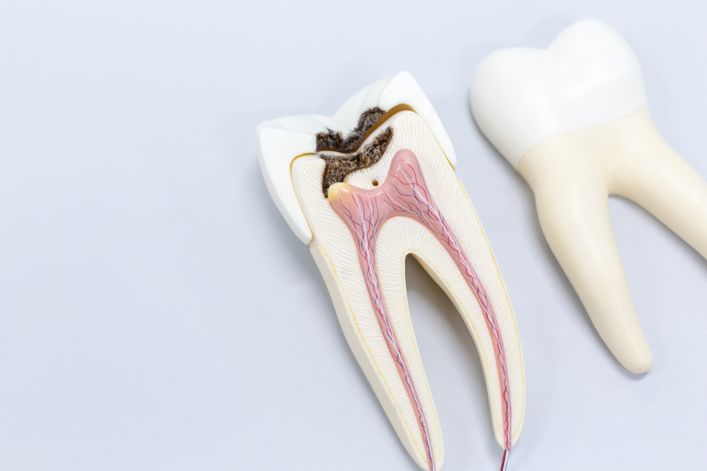 root canal price Canada