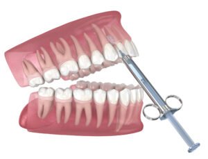 what is an arch in dentures