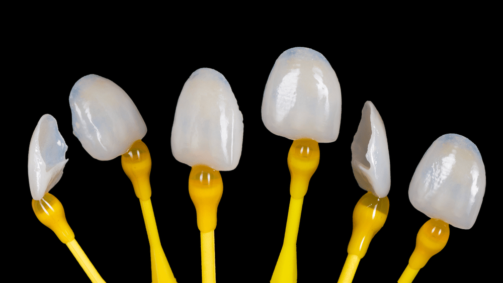 How to Care for Your Veneers: A Complete Guide