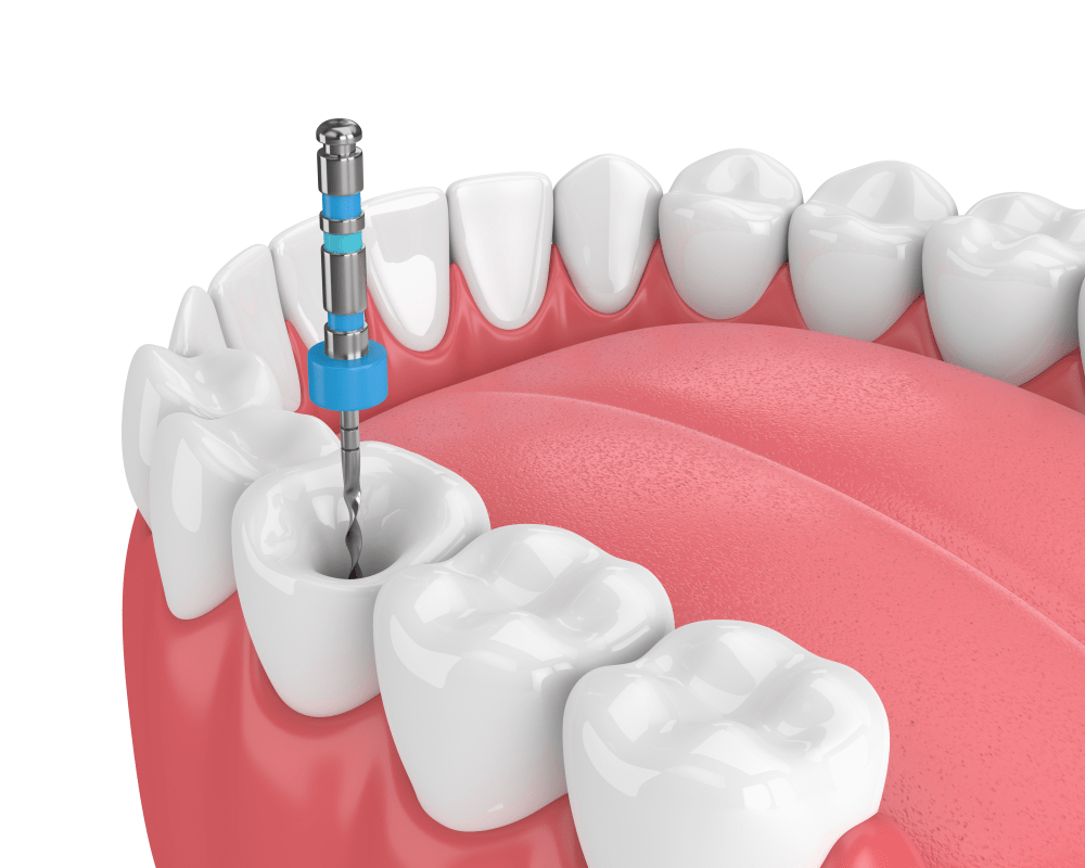 how to tell if u need a root canal