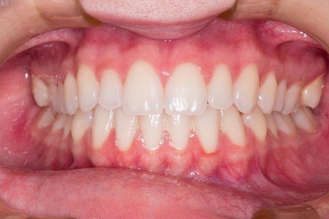Managing tooth sensitivity after a professional dental cleaning in Richmond Hill