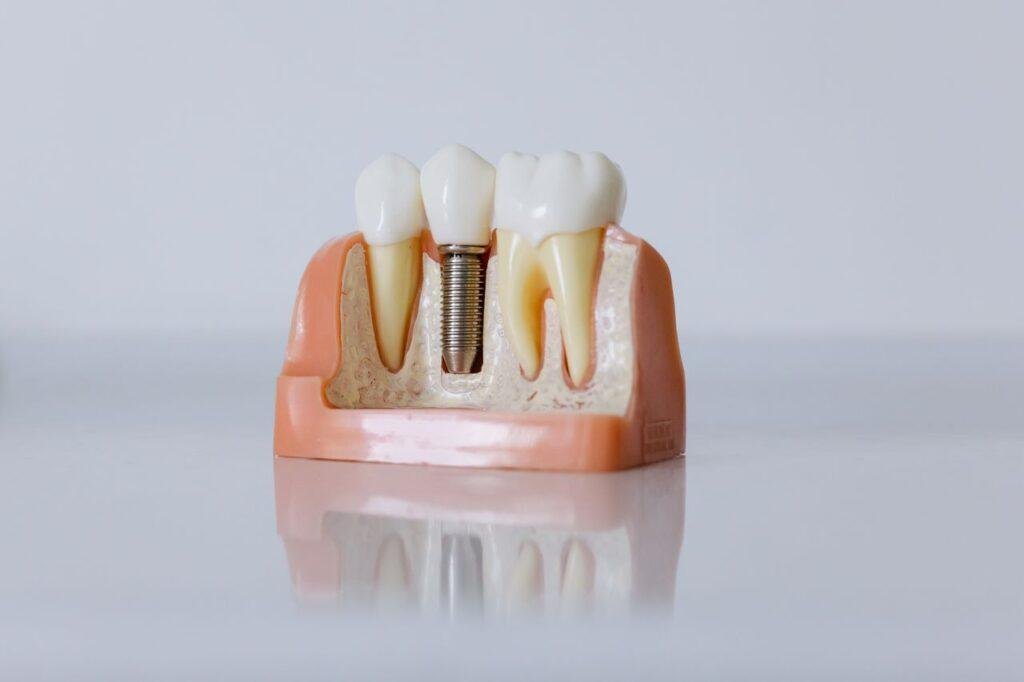 Dentist showing a patient a custom night guard for teeth grinding in Richmond Hill