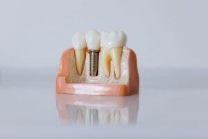 Dentist showing a patient a custom night guard for teeth grinding in Richmond Hill