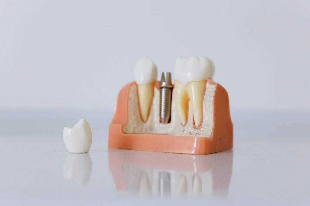 Dental implant model showing a titanium post placed in the jawbone