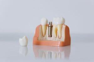 Dental implant model showing a titanium post placed in the jawbone