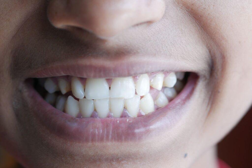 Close-up of a natural smile with a single replaced tooth