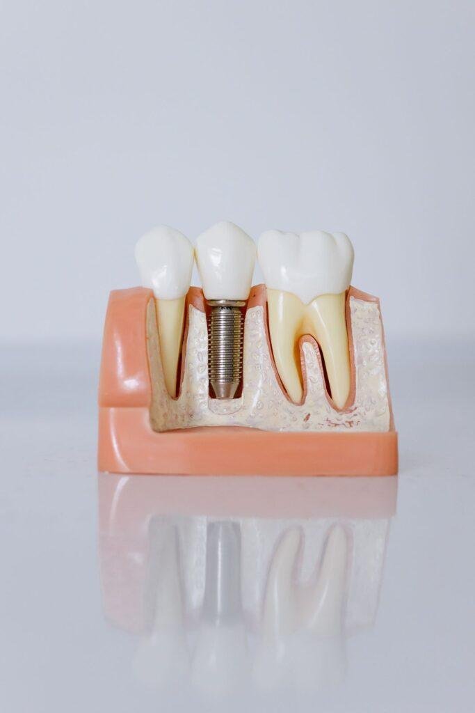 Dental implant model showing support for replacement teeth and jawbone